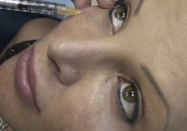 Коррекция носослезной борозды препаратом AestheFill со скидкой 15% на Проспекте Вернадского